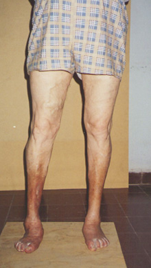 pie plano valgo