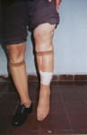 secuela