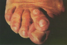 pie plano valgo